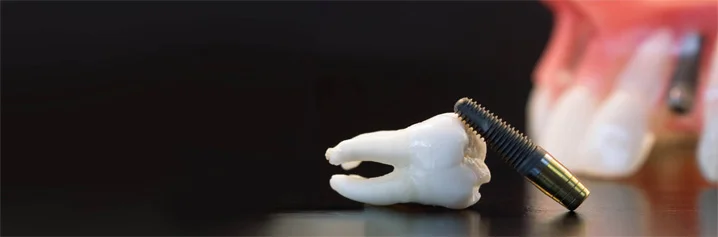 What Is The Basic Cost Of A Dental Implant?