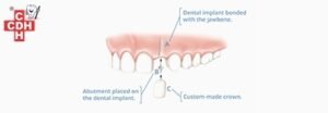 Who can get Dental Implants and what are the measures for better results.