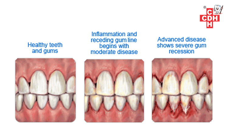 How do I know if I am undergoing gum disease?