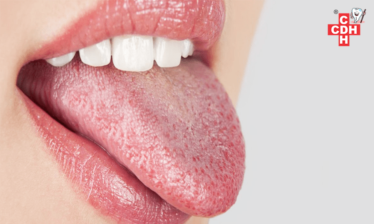 Should I worry about having a dry mouth?