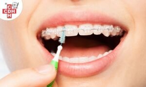 How to keep Braces clean?