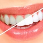 Effects of teeth whitening