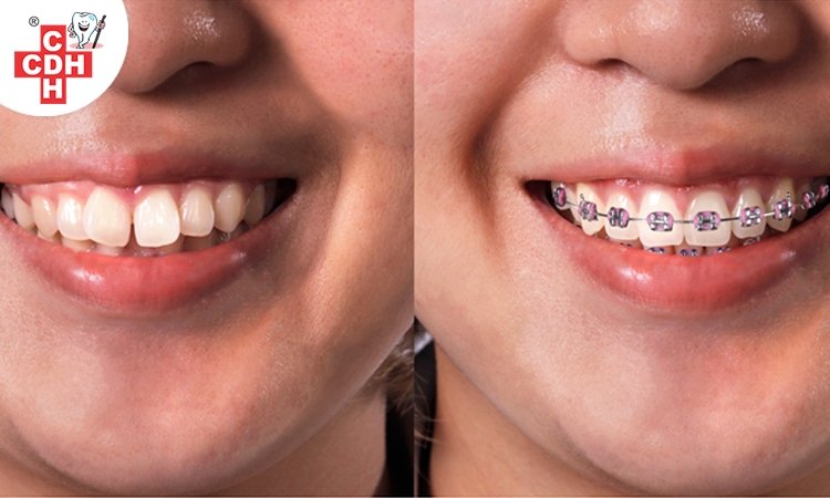 How to fix the gap in front teeth City Dental Hospital