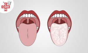 Oral thrush everything you would like to know