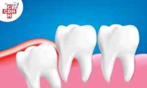 all you need to know about impacted wisdom tooth