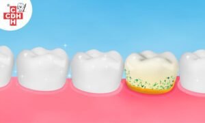 What is dental plaque and how can i get rid of it