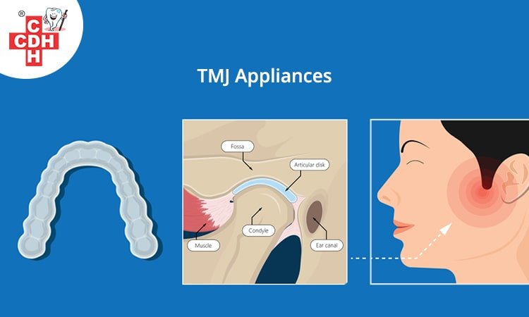 What are TMJ appliances