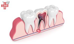 What is the home remedy for root canal infection