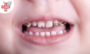 causes and prevention of early childhood caries