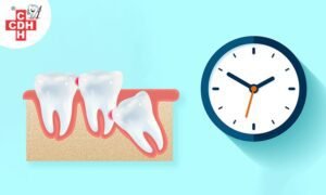 How much time does it take for wisdom teeth to appear