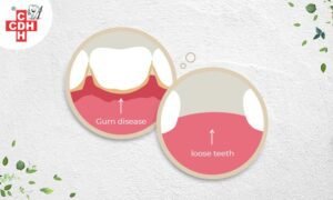 What are natural medicines for gum disease and loose teeth