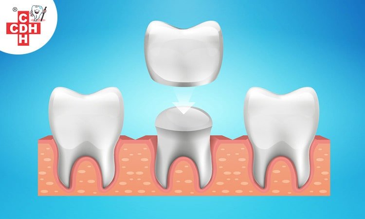 Why are dental crowns necessary after root canal treatment