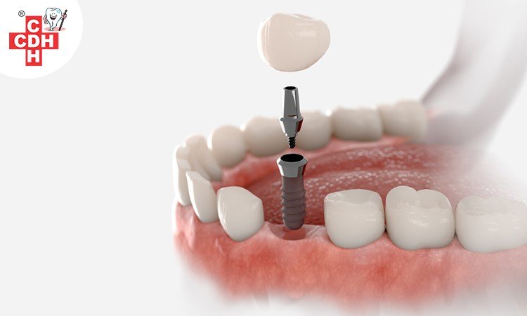 Understanding the procedure and care of implant supported dentures