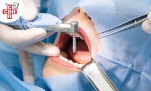 How long does Dental Implant treatment Take