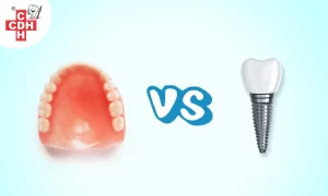 Dentures Vs Dental Implants