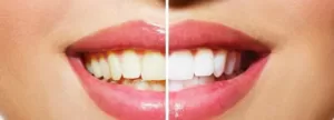 Teeth Whitening