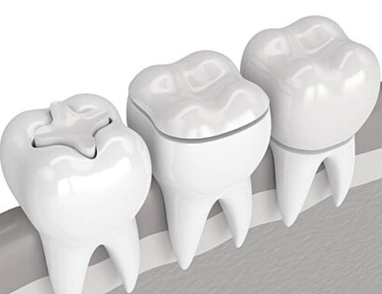 Tooth-Colored Filling