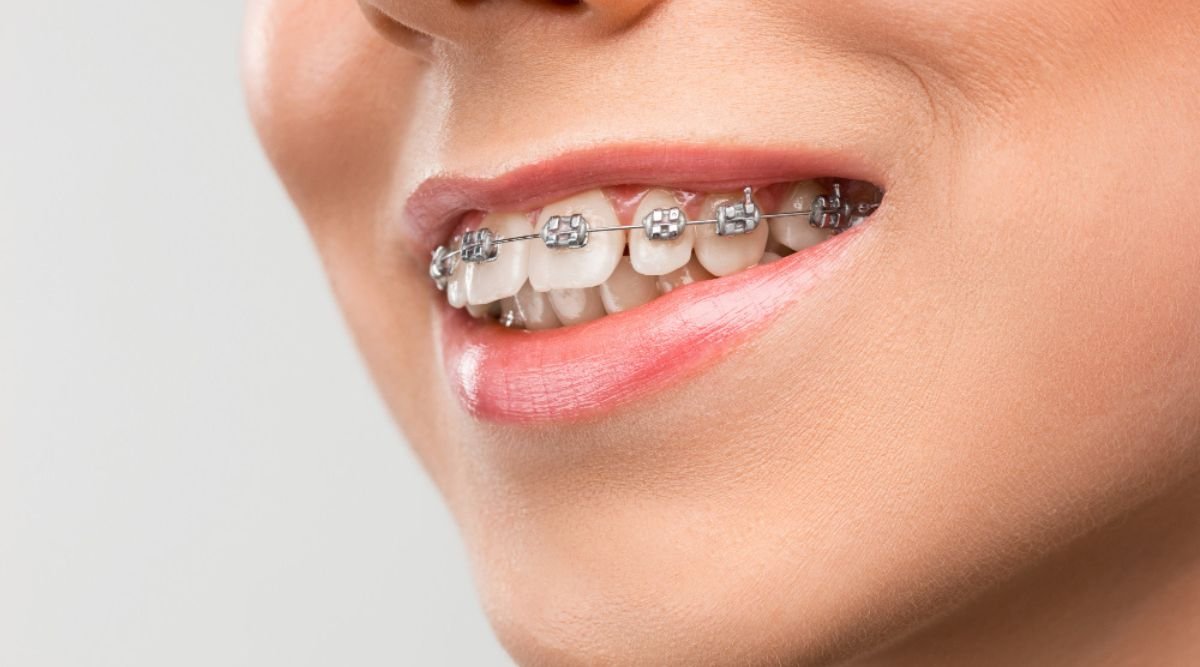 Braces Cost In India | Teeth Braces Price in India