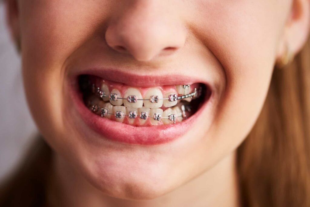Traditional braces / Metal braces