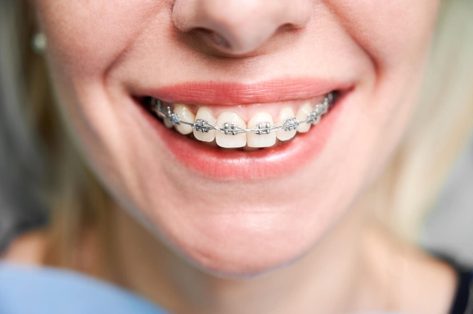 Braces Cost In India, Types,Procedure, Pros and Cons