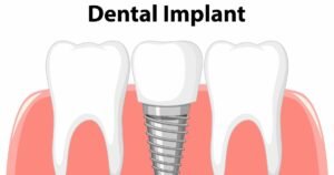 Dental Implant Cost In India