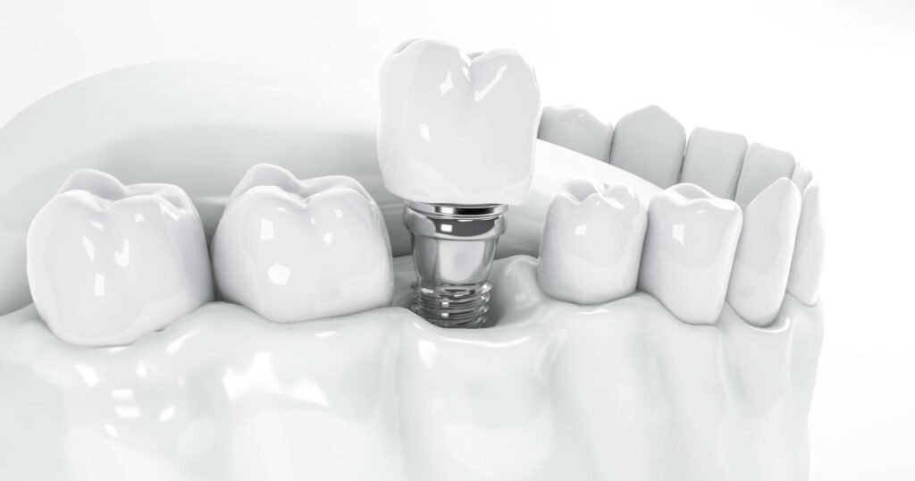 Single Tooth Implant