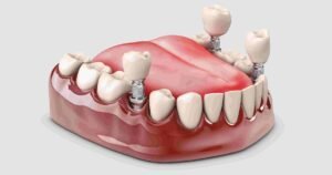 Dental Implants near me