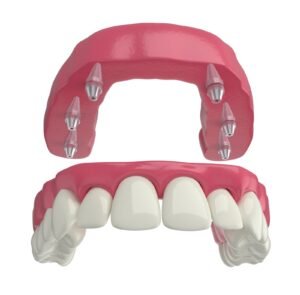 All on 6 dental implants