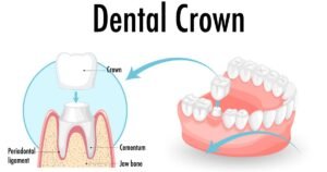 Teeth cap price