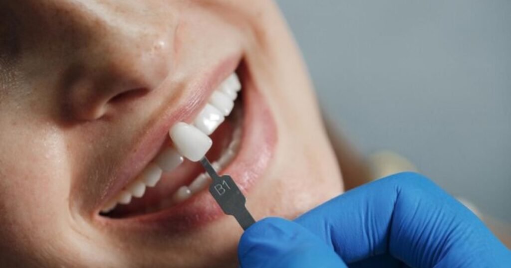tooth cap cost in india