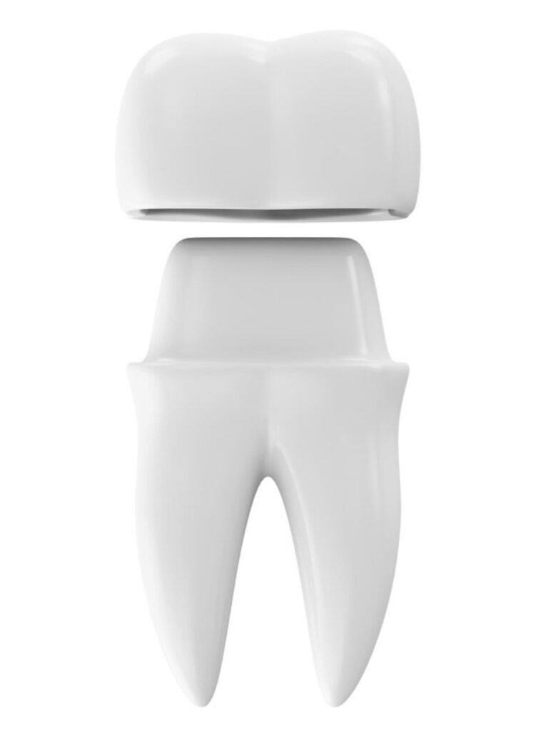 Teeth Cap Price Types, Procedure, Importance