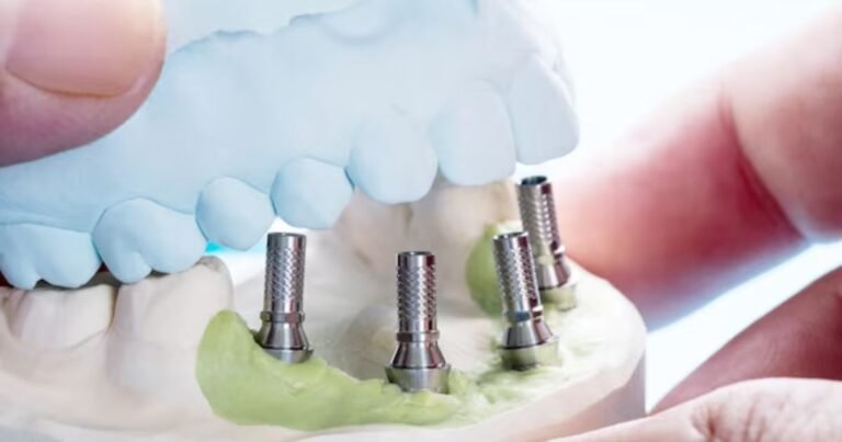 all on 4 dental implants