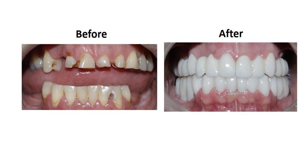 smile makeover before after