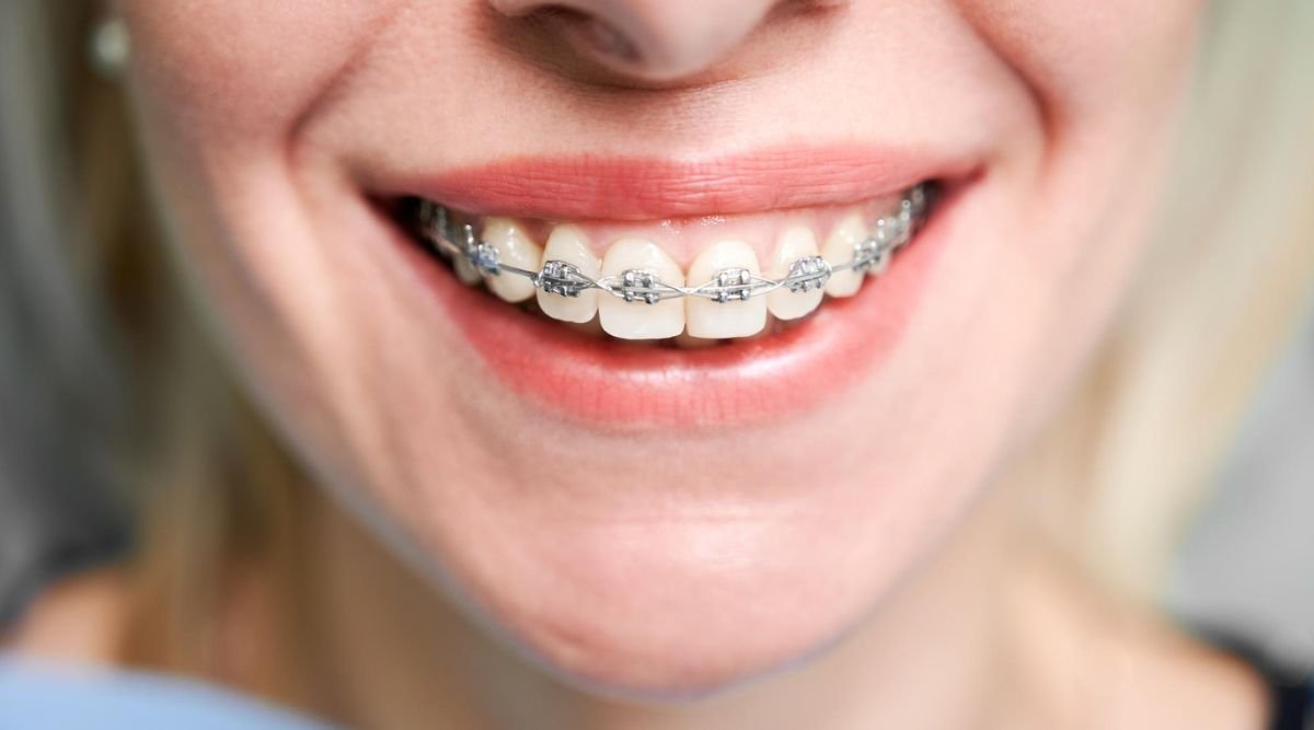  Close-up of traditional metal braces used for orthodontic treatment at City Dental Hospital.