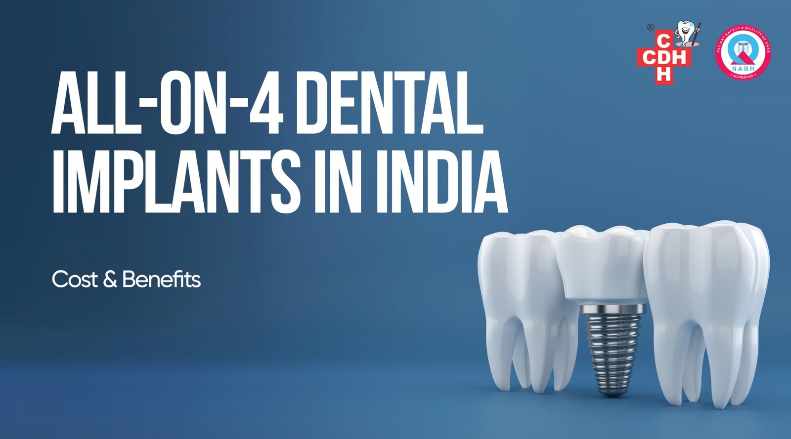 All-on-4 Dental Implants in India