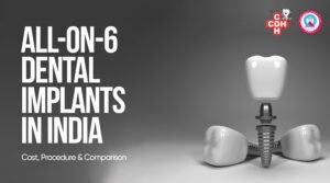 What Are All-on-6 Dental Implants
