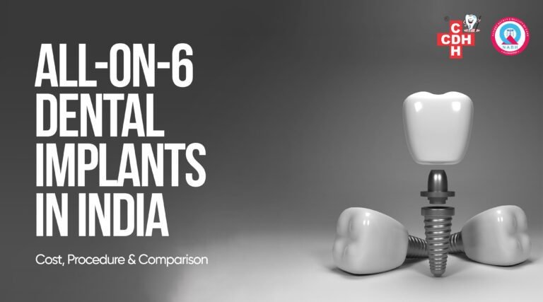 What Are All-on-6 Dental Implants