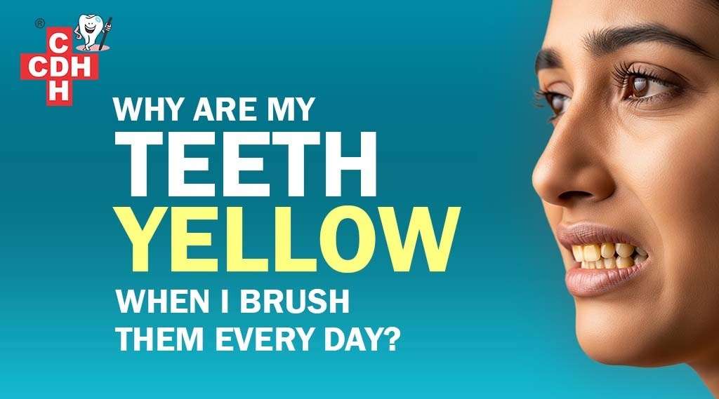 Side profile of a woman grimacing to show her yellow teeth, illustrating the issue of yellow teeth at City Dental Hospital, Rajkot.