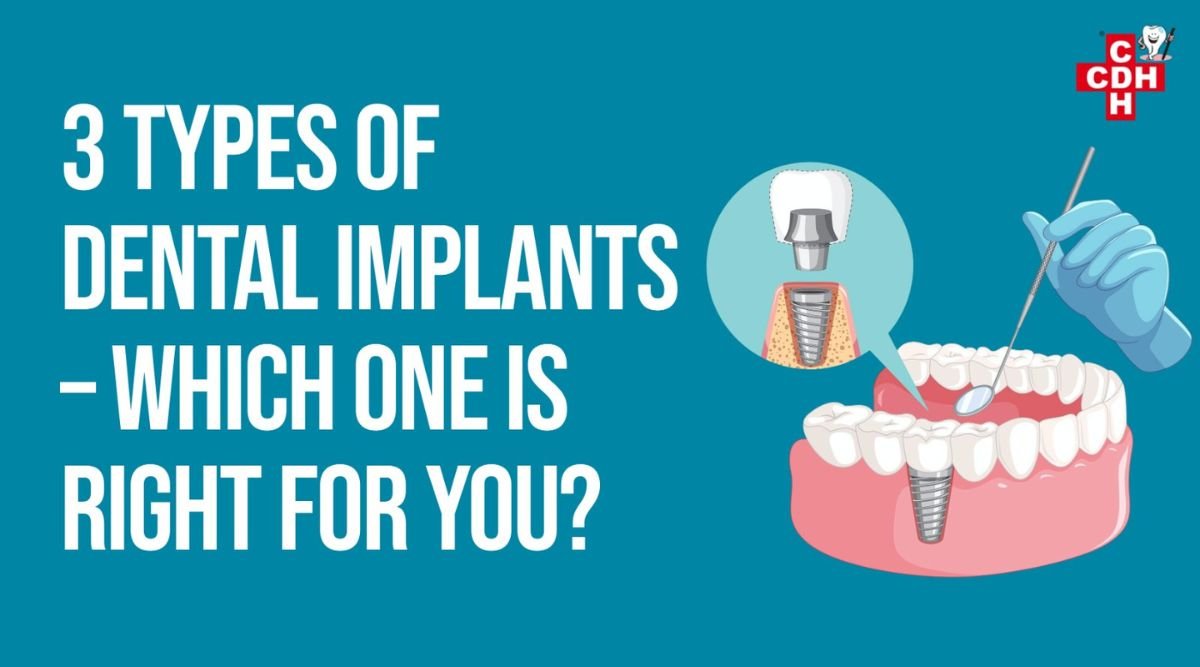 3 Types of Dental Implants – Which One is Right for You