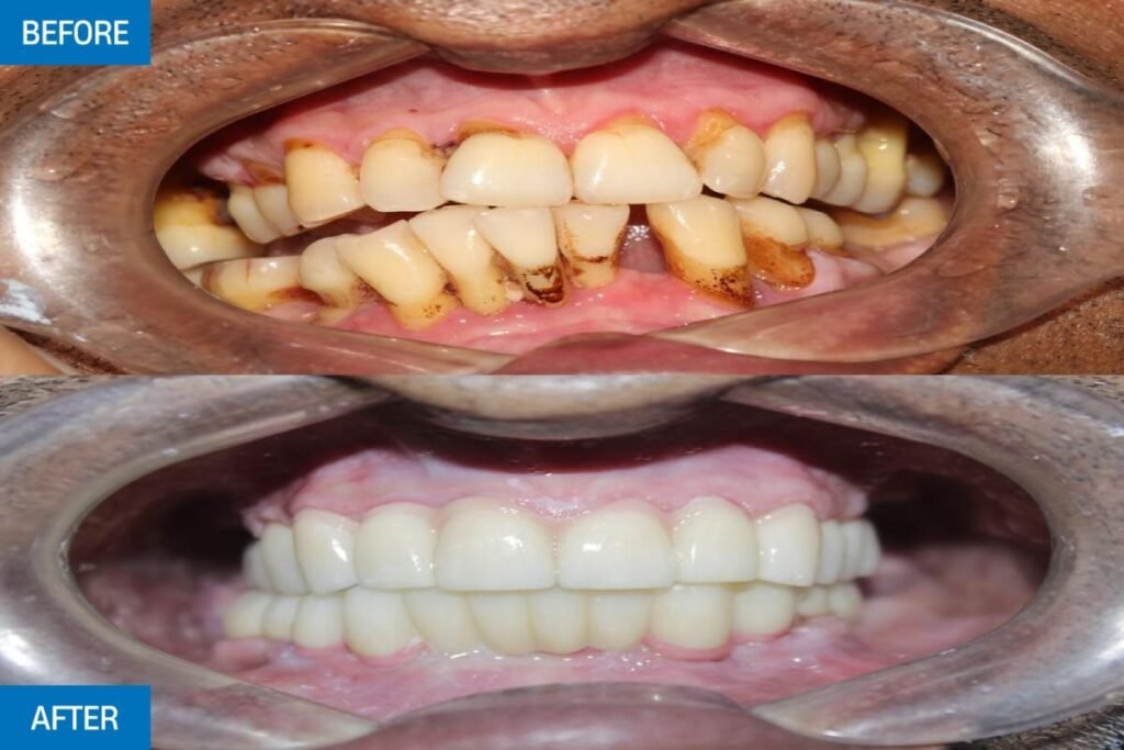 Full mouth rehabilitation before and after results at City Dental Hospital for international dental tourism patients.