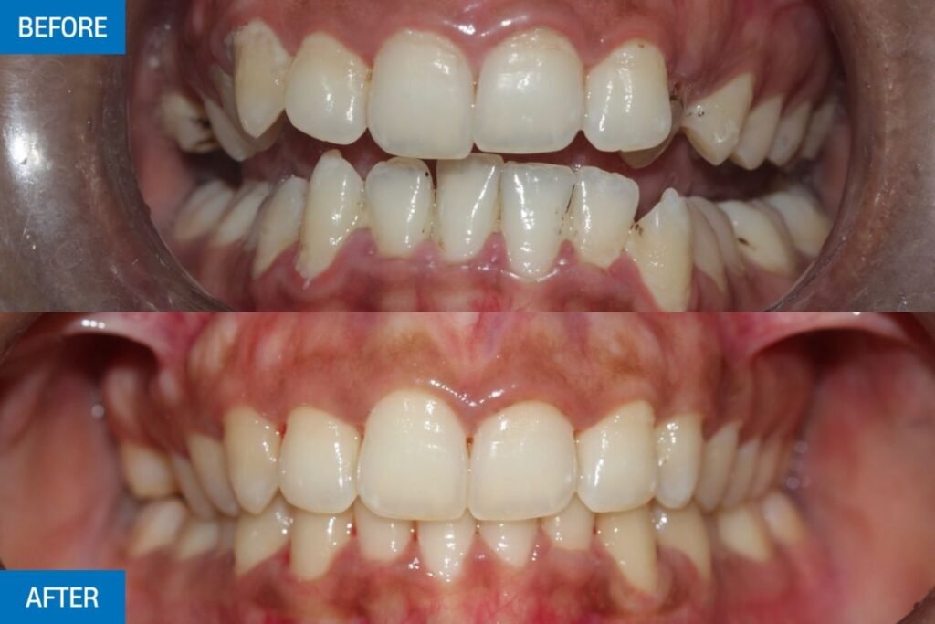 Invisible aligner before and after results at City Dental Hospital for international dental tourism patients.